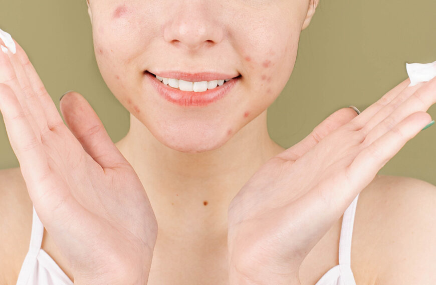 7 Little Known Acne Skin Care Secrets